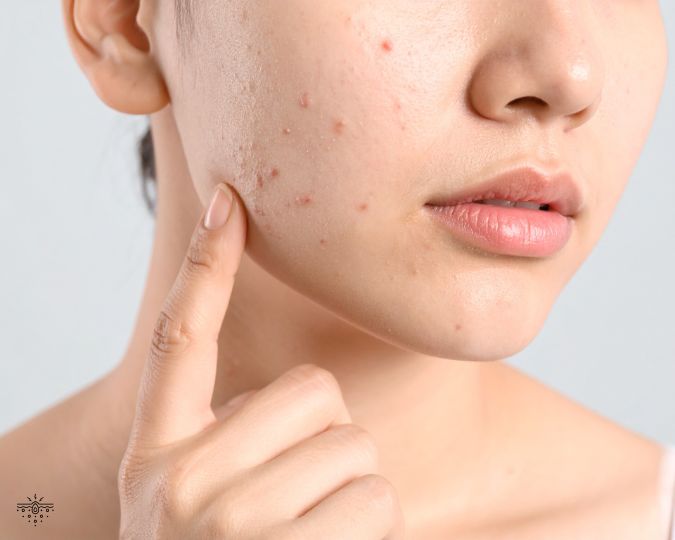Teen acne: why early treatment matters (and what actually works)