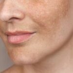 melasma in winter