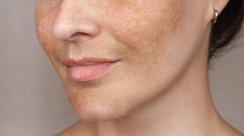 melasma in winter