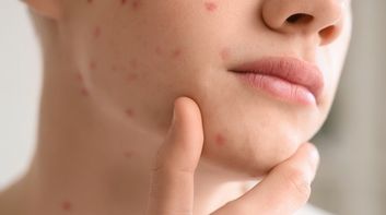 Teen acne: why early treatment matters (and what actually works)