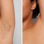 laser hair reduction sessions