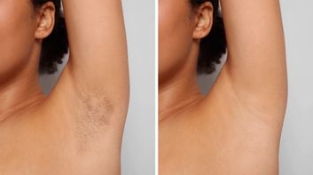 laser hair reduction sessions