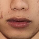 Can acne scars go away on their own