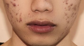 Can acne scars go away on their own