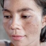 why does pigmentation keep coming back