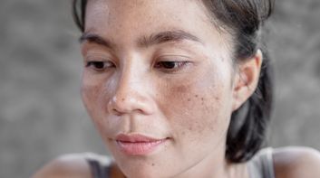 why does pigmentation keep coming back