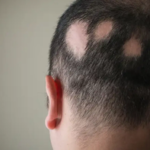 hair regrowth after alopecia areata