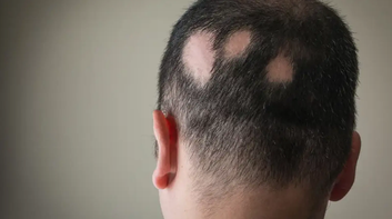 Can your hair grow back after alopecia areata?