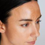 best treatment for melasma