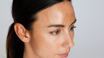 What is the best treatment for melasma?