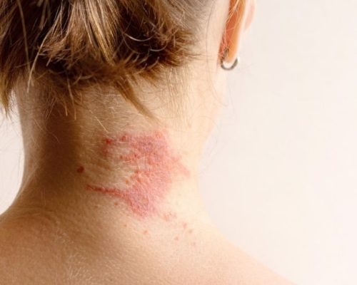 skin autoimmune disorders