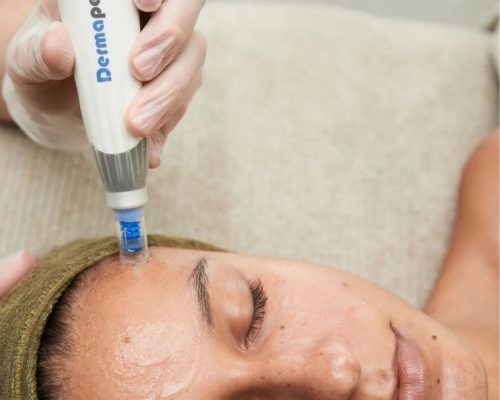 dermapen 4 microneedling