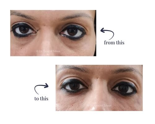 under eye filler results