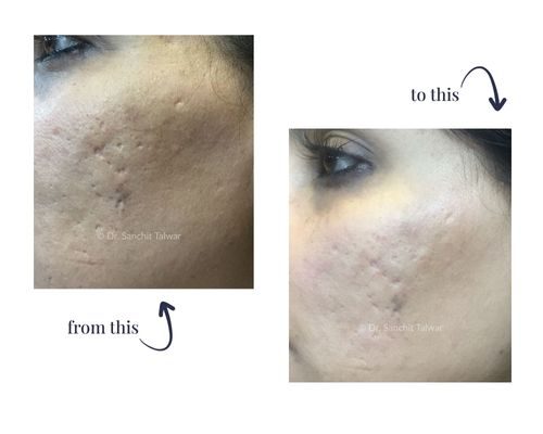 fractional co2 for acne scars