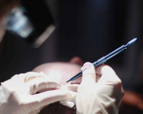 hair transplant chandigarh