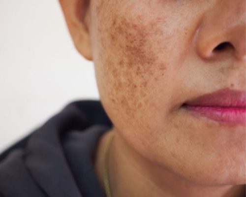 melasma treatment chandigarh