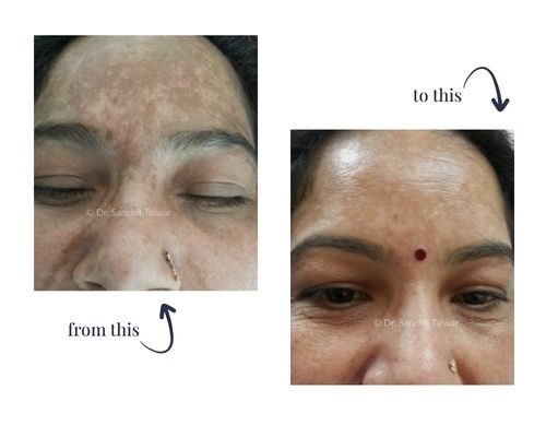 melasma treatment result
