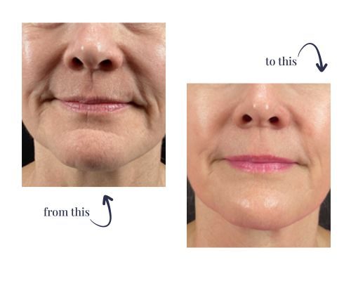 morpheus8 anti-aging