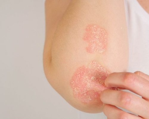 psoriasis treatment