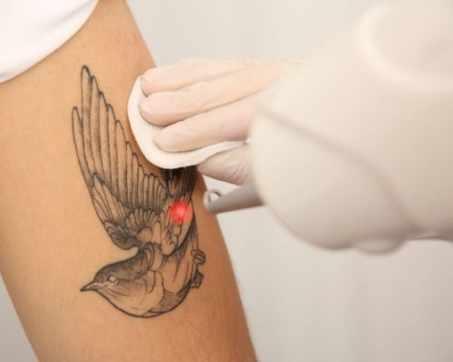 laser tattoo removal