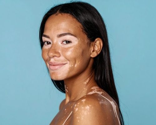 vitiligo treatment
