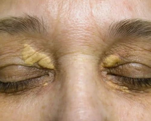 xanthoma under eye